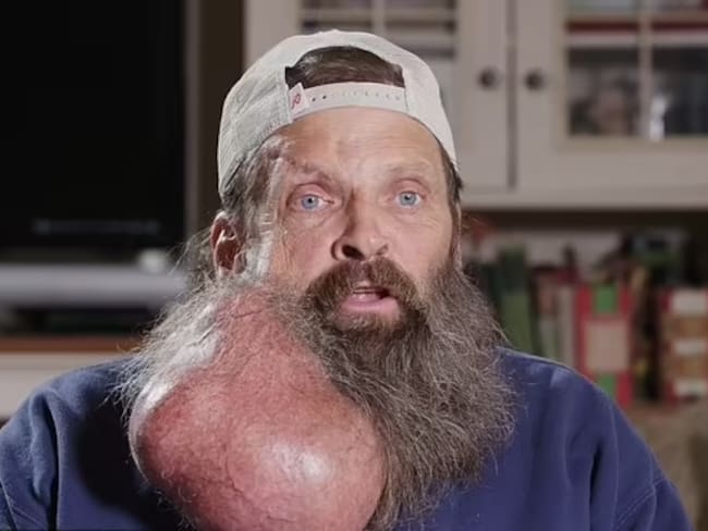 “Comenzó como un grano”: hombre desarrolla tumor del tamaño de una sandía en su cuello